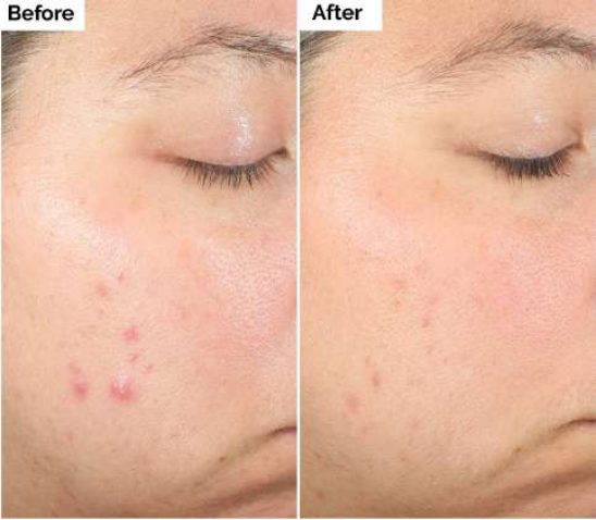 Salicylic Acid 2% Solution, Exfoliating Serum for Acne, foto 2